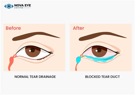 tear drainage test|surgery for blocked tear duct.